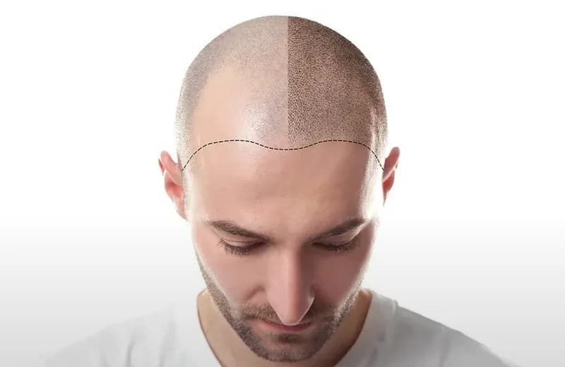 Scalp Micropigmentation Benefits 2026 | Therapeutic Cuts — Therapeutic Cuts Benefits guide card image