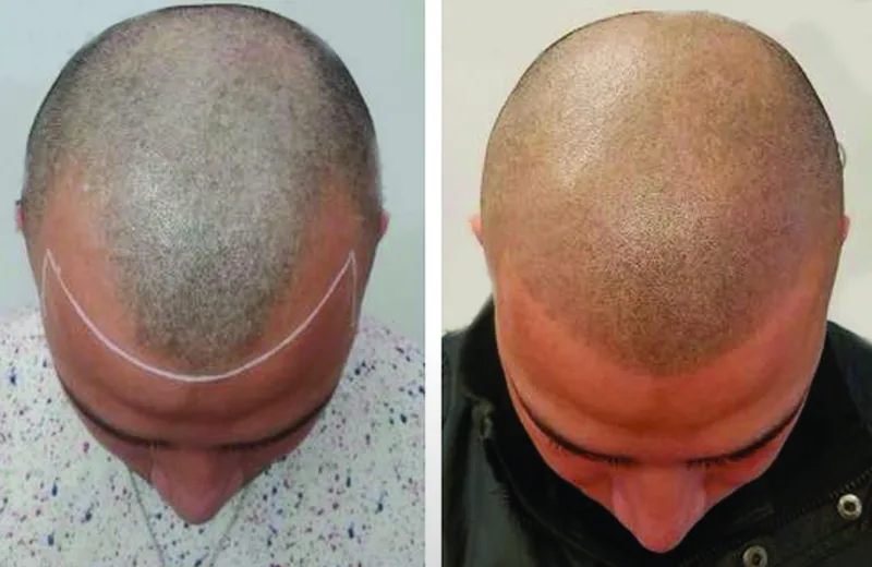 SMP for Crown Thinning Queens NYC | Vertex Hair Loss Solution & Results — Therapeutic Cuts SMP Crown guide card image