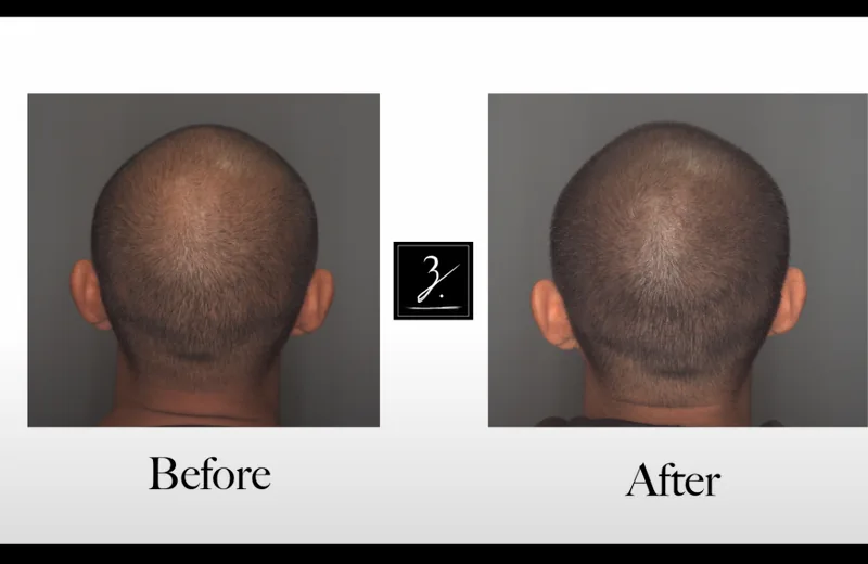 SMP vs Wigs & Hair Systems 2026: Cost, Maintenance & Results Comparison — Therapeutic Cuts SMP Comparison guide card image