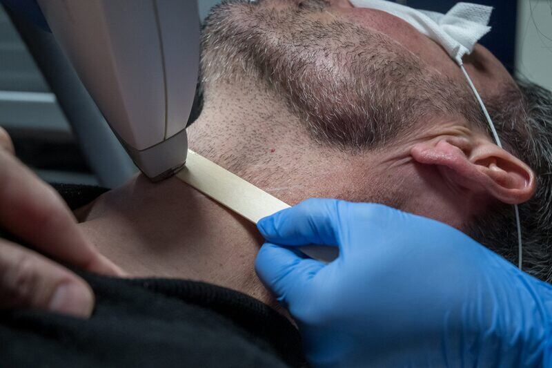 Professional laser hair removal treatment for men’s beard lines in Queens