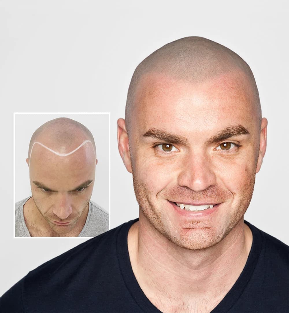 Professional scalp micropigmentation treatment showing SMP cost and pricing in NYC Queens