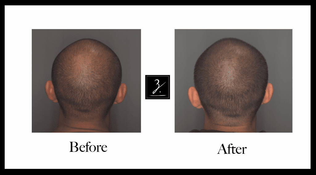 Scalp micropigmentation before after photos - Real SMP results Queens NYC