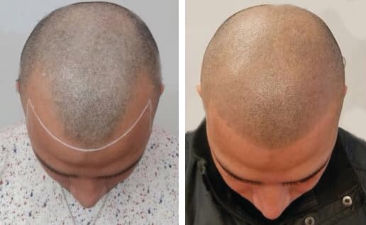 How long does scalp micropigmentation last - SMP longevity and durability 2026