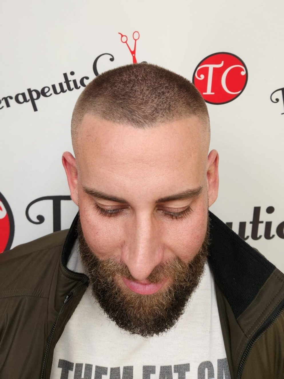 After Scalp Micropigmentation