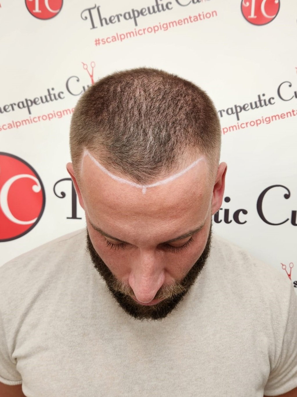 Before Scalp Micropigmentation