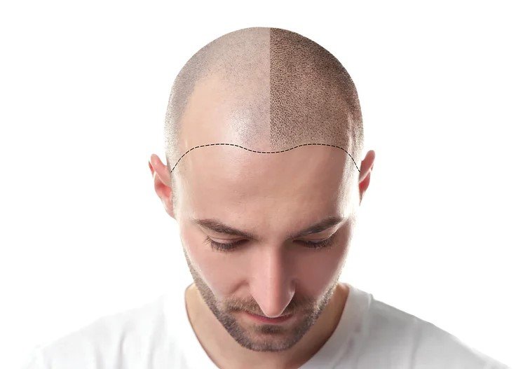 Scalp Micropigmentation Result